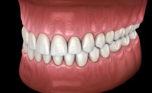 an orthodontic dental model with an overbite conditon
