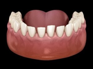 an orthodontic model of the bottom teeth with spacing issues