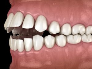 an orthodontic dental model of a mouth with an open bite condition
