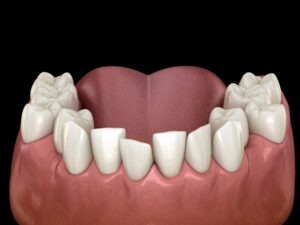 a dental model with crooked and spacing issues