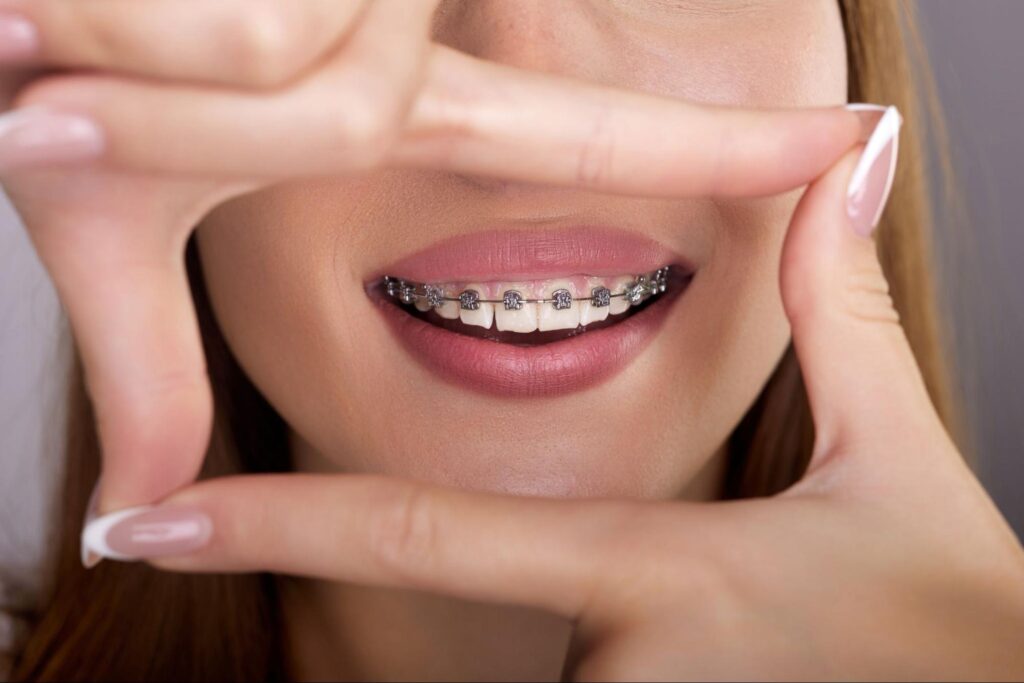 What Really Works to Relieve Braces Discomfort
