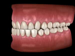 an orthodontic dental model of a mouth with an underbite condition