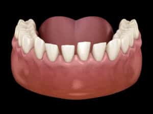 an orthodontic model of the bottom teeth with spacing issues