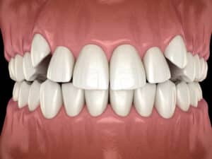 a orthodontic dental model of impacted canine teeth