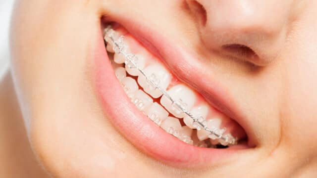 Happy,Smile,Of,Young,Woman,With,Dental,Braces