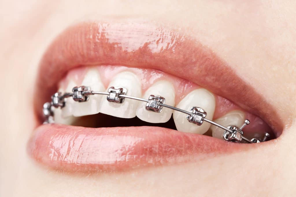 SelfLigating Braces vs Traditional Braces DiCiccio Freeman Orthodontics