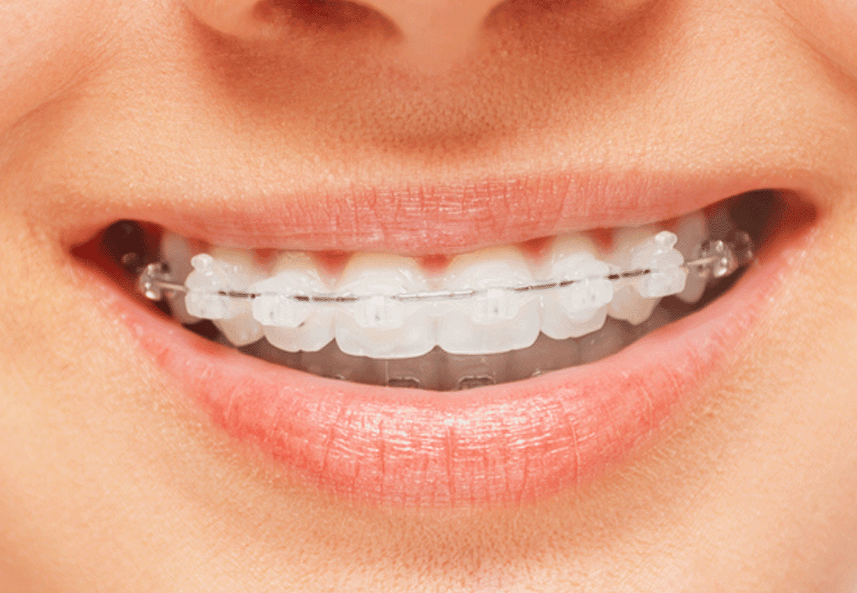 Woman smile: teeth with damon clear braces, dental care concept, front view