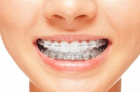 Female smile: teeth with braces, dental care concept, front view