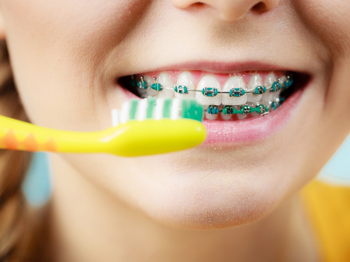 A young girl with braces is brushing her teeth with a yellow toothbrush