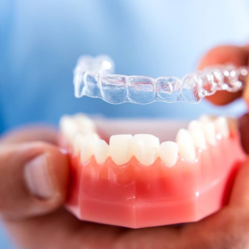 Close-up. The doctor puts clear aligners on the teeth of the artificial jaw
