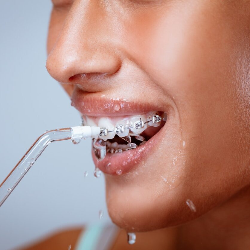 Close-up of a smiling woman face with braces cleaning her teeth with oral irrigator.